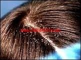 أسباب قشرة الشعر والوقاية منها