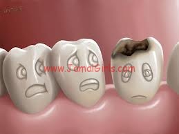 علاج تسوس االاسنان والوقاية منه
